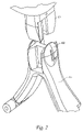 US-7178666-B2 figure 5