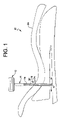 US-7624737-B2 figure 3